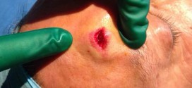 L’agression Nabil Benabdallah nécessite 7 Points de suture
