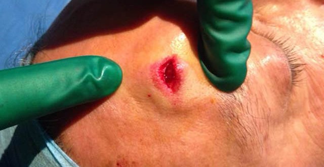 L’agression Nabil Benabdallah nécessite 7 Points de suture